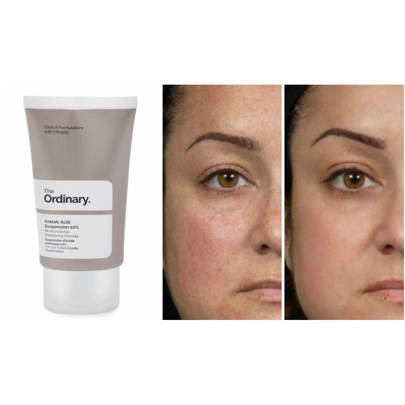 The Ordinary Azelaic Acid Suspension 10 Auramart.lk